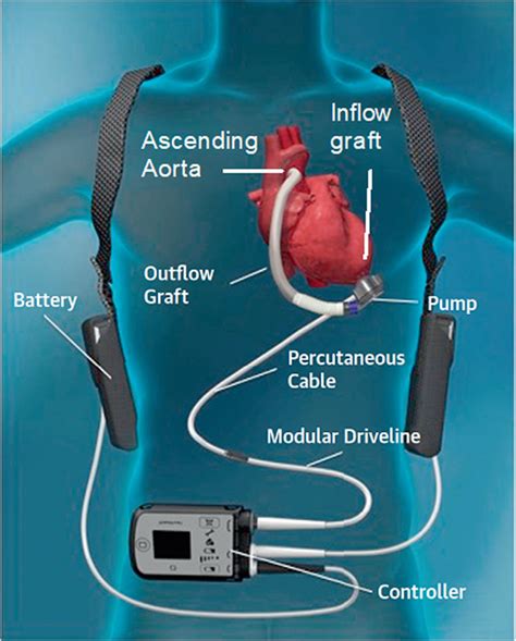 bills a screw pump heart|Impella Left Ventricular Assist Device .